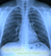 肺癌のレントゲン写真